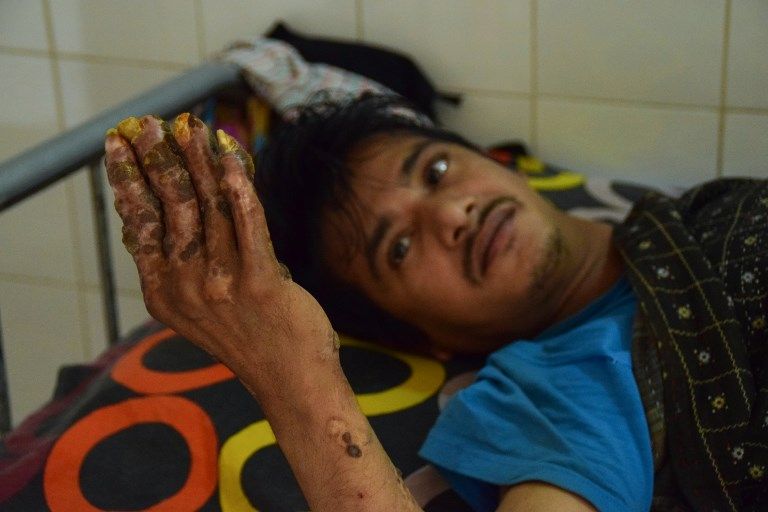 孟加拉「樹人」(tree-man)巴強達(Abul Bajandar)手腳再度長出像樹皮的增生物。(AFP)