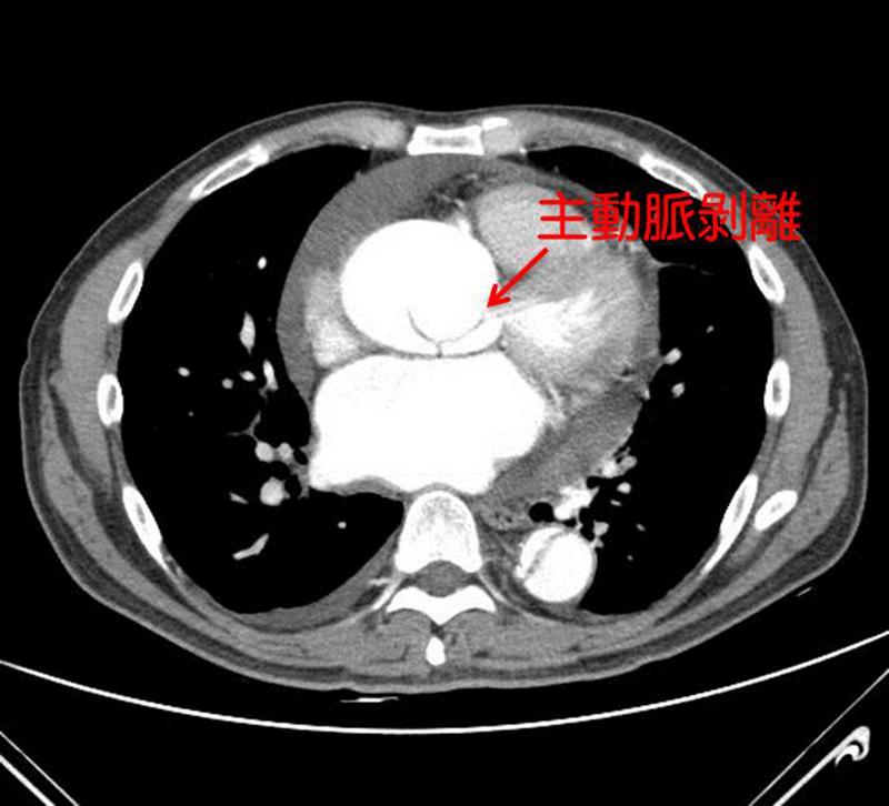 醫師指出，主動脈是身體最大動脈，負責將心臟的血液通往全身，若主動脈剝離，會造成全身血液供應問題，造成器官缺氧壞死，典型症狀為前胸到後背產生撕裂般劇痛。（國泰綜合醫院提供）