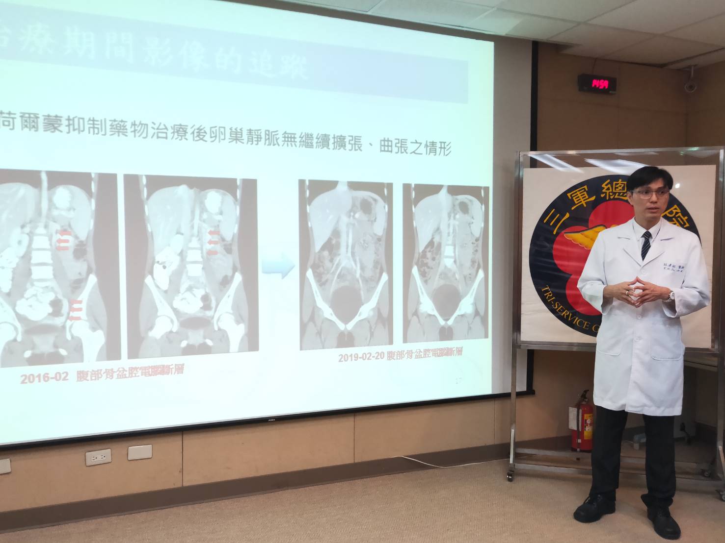 三軍總醫院12日提出一起罕見病例，患者是一名10多歲女童，2歲起就經常腹痛但找不出原因，經全身檢查確診為骨盆腔鬱血症候群。(蕭照平 攝)