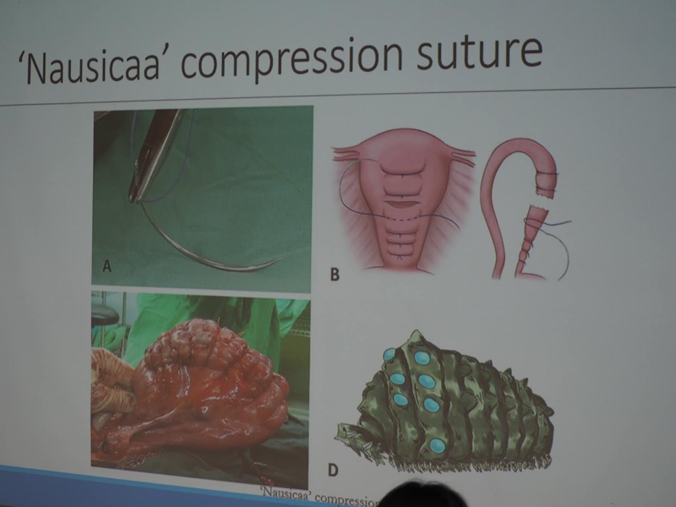 台大醫院發表可以有效止血、免摘除子宮的「王蟲縫合術」。(蕭照平攝)