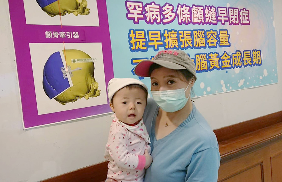 嬰兒頭型像卡通「辛普森家庭」的角色可不能輕忽，醫師提醒，這可能是罹患顱縫早閉罕見疾病所造成的頭顱畸形罕，如果沒有及早進行擴張，恐會錯失大腦發育黃金期。(林口長庚紀念醫院提供)