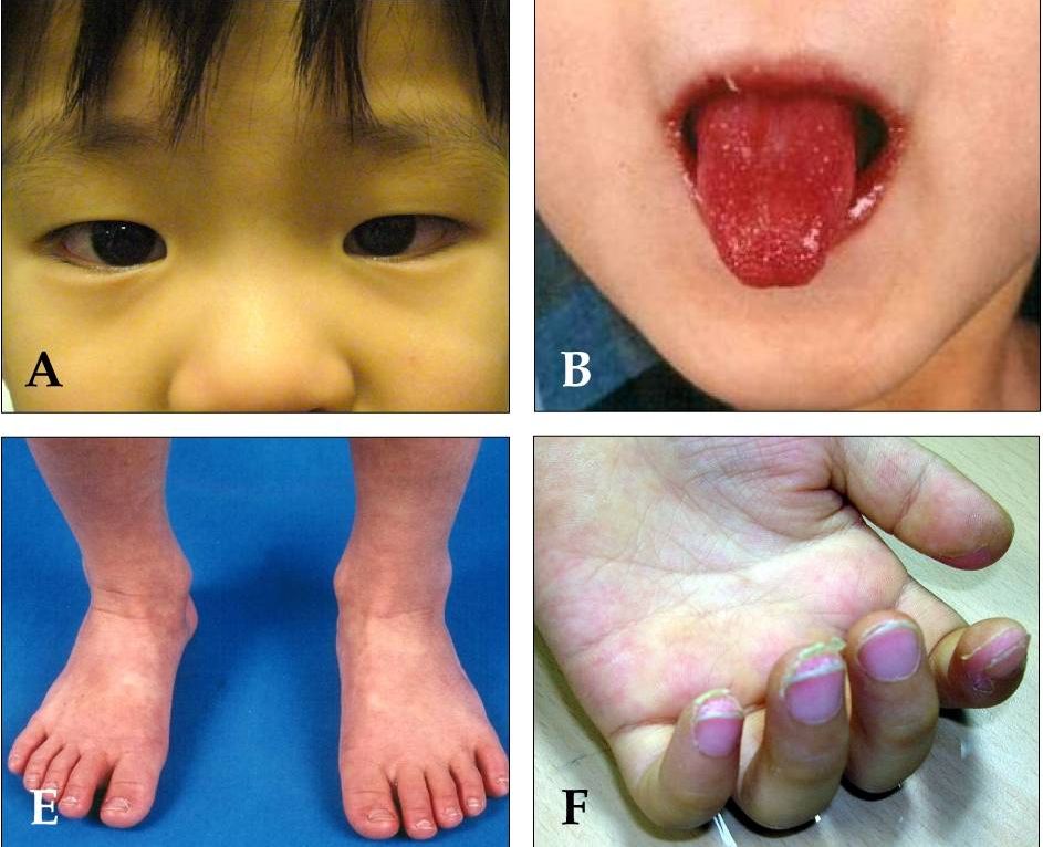 全身起疹、眼睛發紅、手腳浮腫，都是川崎症(Kawasaki Disease)的典型症狀。(圖：取自維基百科)