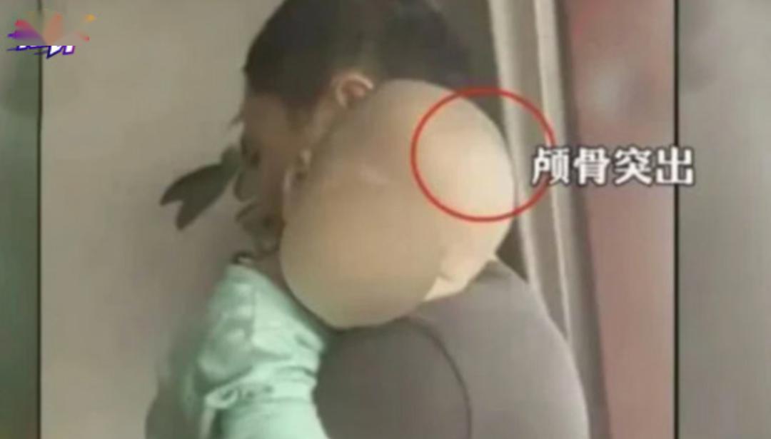 中國湖南近期發生多名兒童在食用一款奶粉後，因營養不良罹患佝僂病，事件令社會想起2003年安徽劣質奶粉的「大頭娃娃」及2008年三聚氰胺毒奶粉事件，陸媒痛批，相關商家喪失基本人性。(圖/微博)