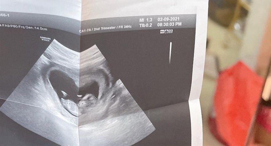 變性網紅「罔腰」自稱懷孕，並秀出超音波照片，但經衛生局調查，証實她本人並未懷孕。  (IG)