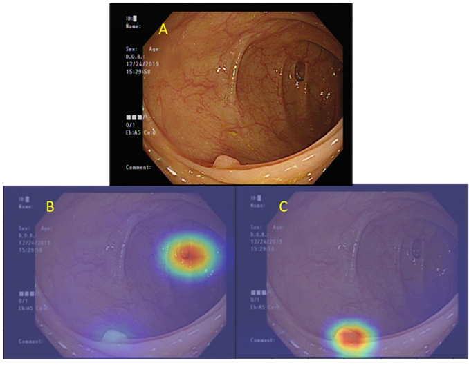當多重大腸病灶同時出現在一張影像上(A)，人工智慧系統也能準確診斷(B)為憩室、(C)為大腸瘜肉。(北榮提供)