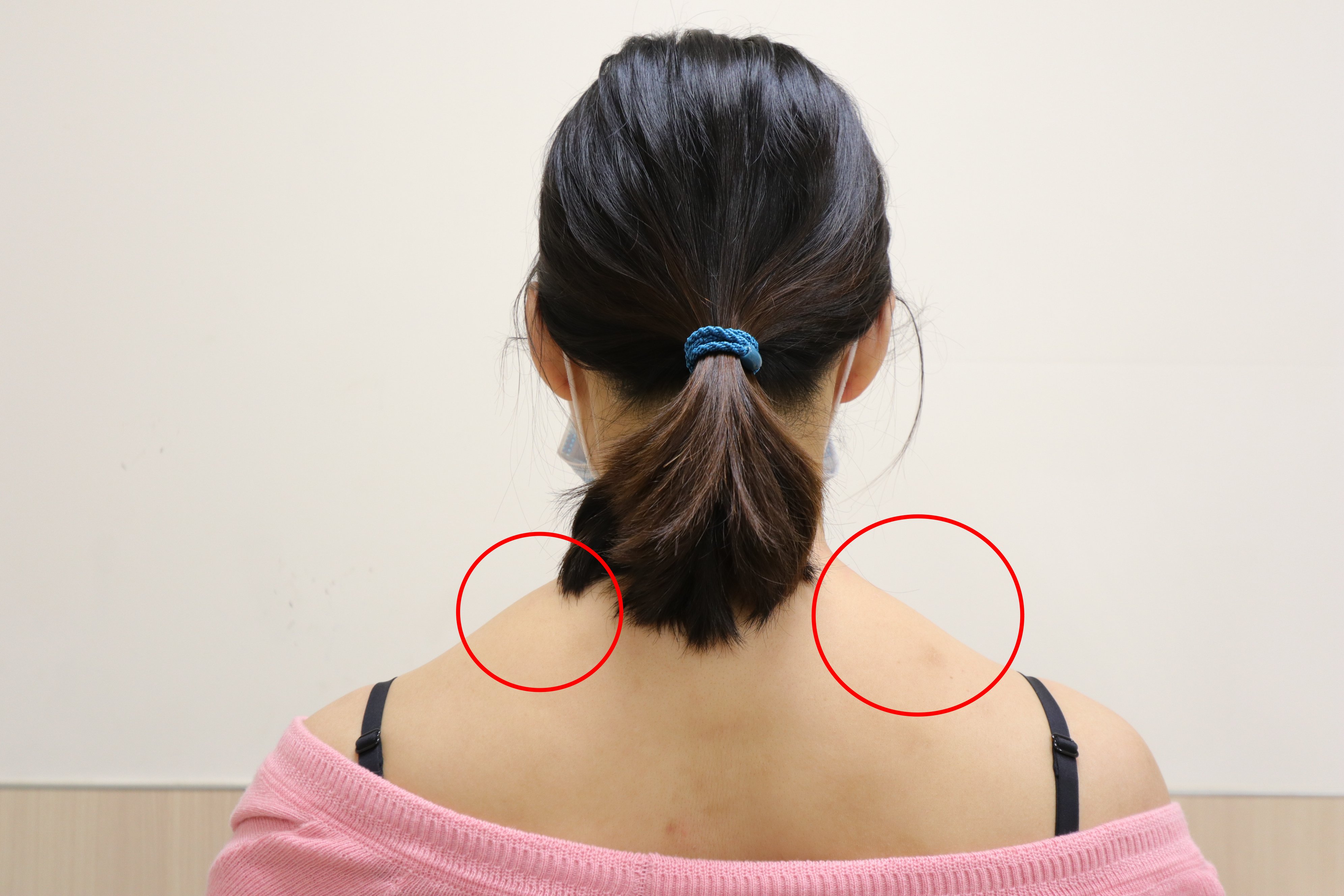 肩膀兩側的「上斜方肌」太過發達，造成肩膀兩側腫得像小山丘一樣。 (亞大醫院提供)