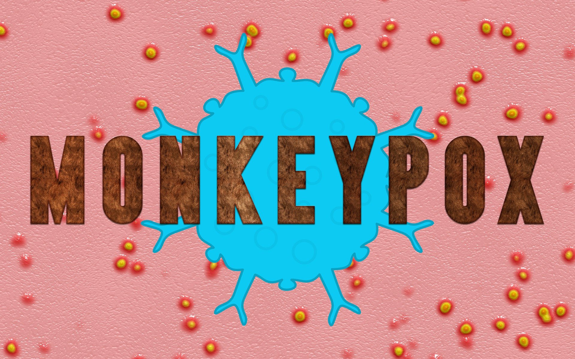 猴痘(monkeypox)。(Pixabay圖庫)