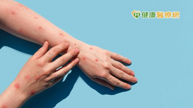 猴痘疫情主要集中在親密接觸者，同性間性行為者，與新冠肺炎的傳播方式不同，目前並無大規模接種疫苗的必要。(圖：健康醫療網 提供)