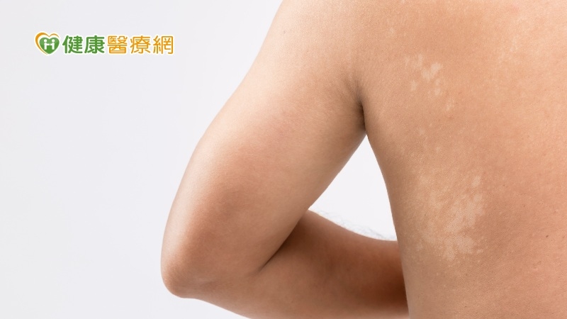 汗斑又稱變色糠疹，它在南台灣濕熱的夏天非常普遍發生。(圖：健康醫療網 提供)