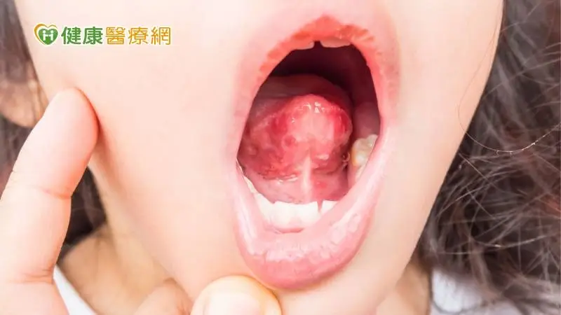 由於腸病毒常造成手口足病，嘴巴的病灶會讓孩童吞嚥時產生疼痛感，而有食慾不振或拒絕進食的狀況，此時可以使用口服止痛藥物或是口腔局部止痛噴劑來減緩孩子的不適。(圖：健康醫療網 提供)