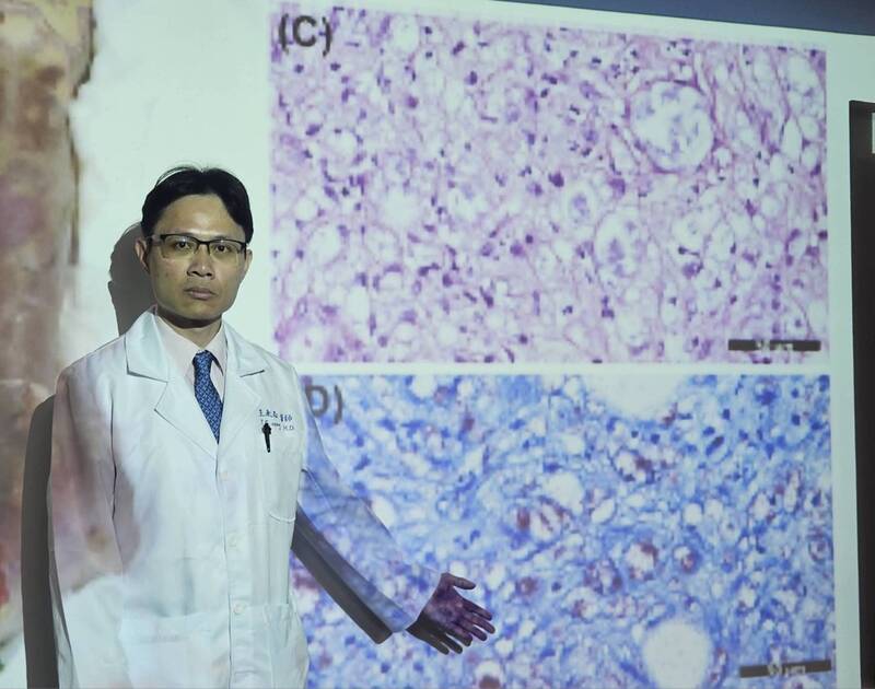 三軍總醫院感染科主治醫師王永志（圖）25日在記者會中發表一起麻生病引發Lucio氏現象的特殊案例報告，個案為一名32歲印尼籍女性移工，由於發生罕見Lucio氏現象，引起壞死性的過敏性血管炎，病程進展快速且具威脅性，個案在搶救近2個月後仍宣告不治。 (圖：中央社)