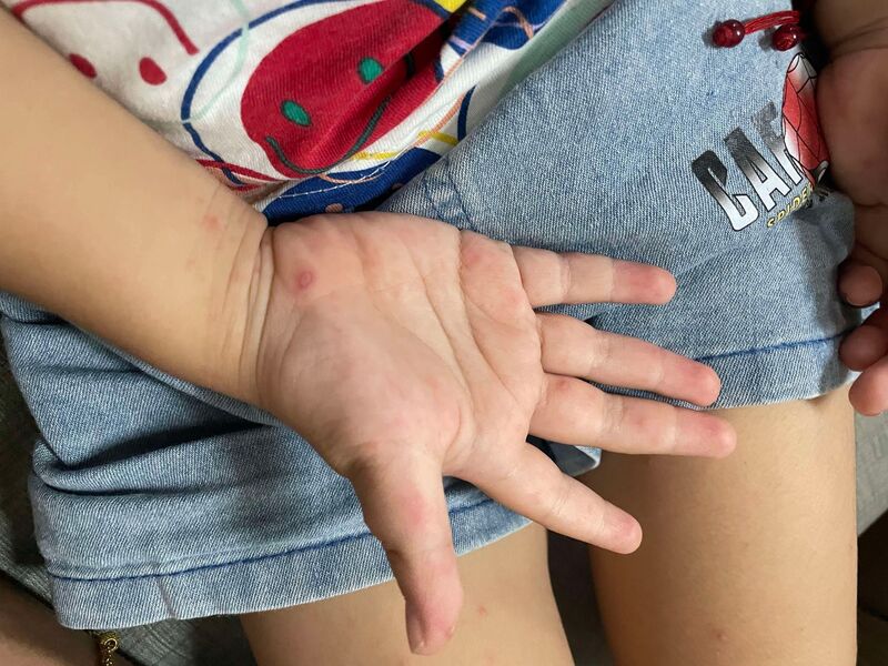 時序進入秋冬，但國內腸病毒疫情仍居高不下，創5年來新高。圖為腸病毒會造成口腔、手掌出現水泡、潰瘍，常會讓小朋友難以進食。(民眾提供/圖：中央社)